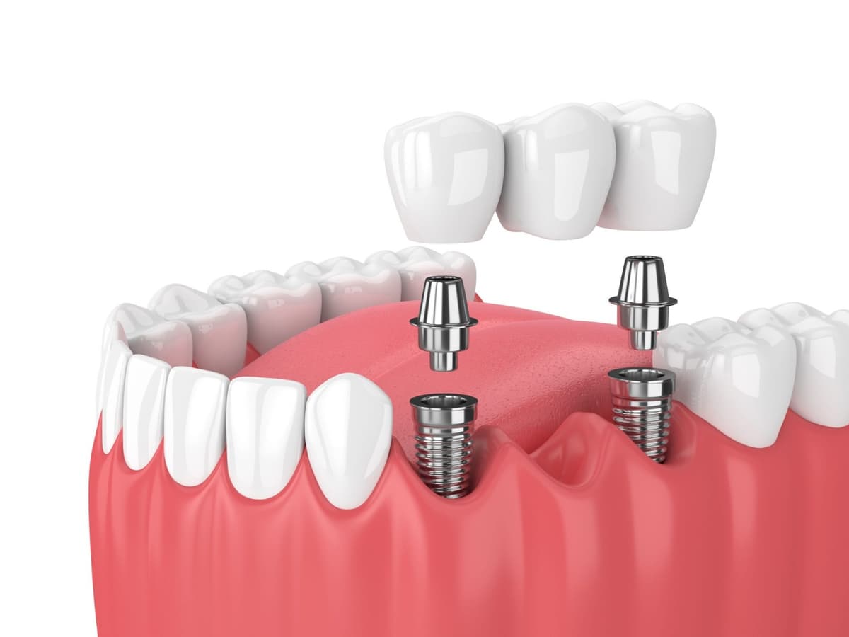 Dental Implants - Main View