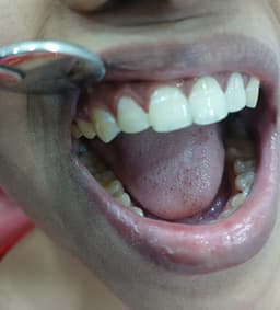 Dental Fillings - Thumbnail 2