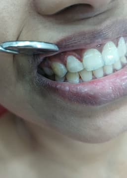 Dental Fillings - Thumbnail 3