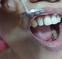 Dental Fillings - Thumbnail 4