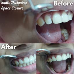 Dental Fillings - Thumbnail 2