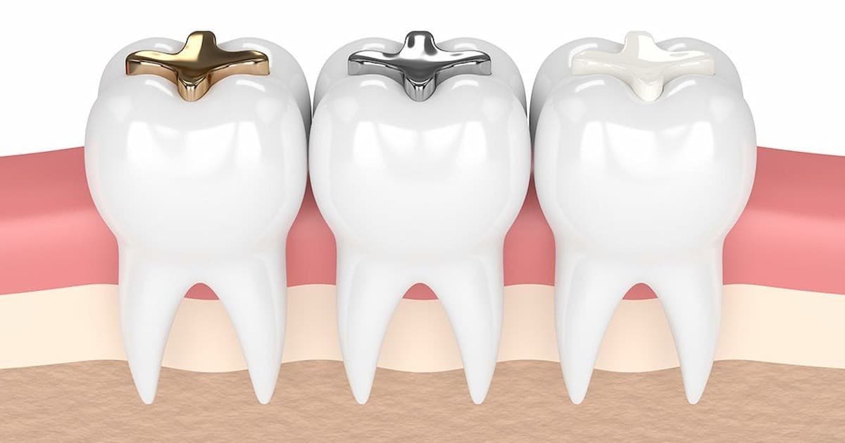Dental Fillings - Main View