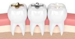 Dental Fillings - Thumbnail 1