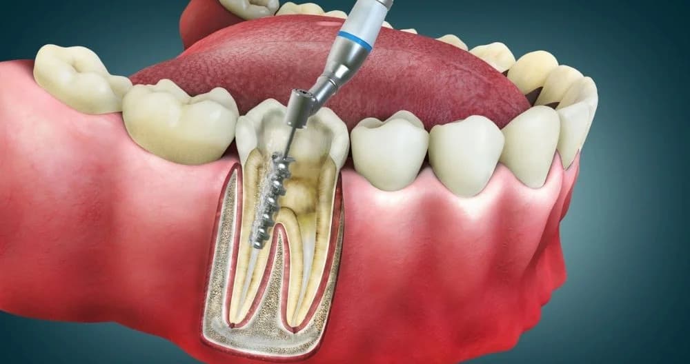 Root Canal Treatment - Main View