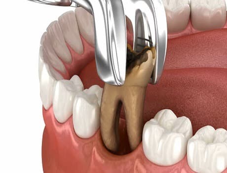 Tooth Extractions - Main View