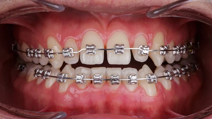 Dental Braces (Orthodontic Treatment)