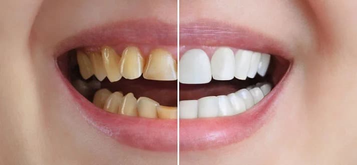 Teeth Scaling, Polishing & Whitening